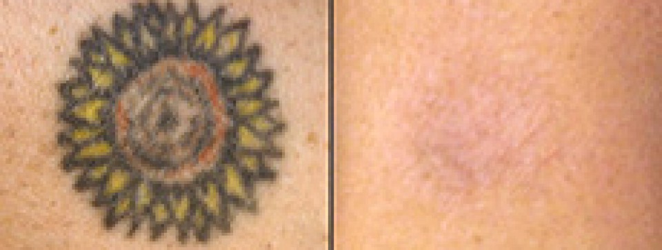 Picosure Tattoo Removal In London